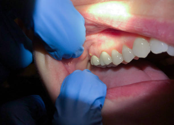 Best Broken or Cracked Tooth Emergency Dentist in Alameda, CA